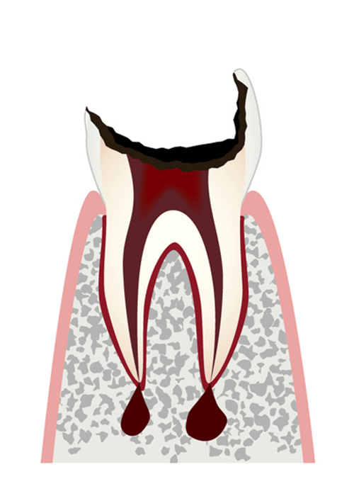 歯冠（しかん）が大きく失われた歯