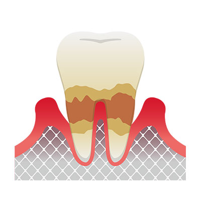 虫歯の検診